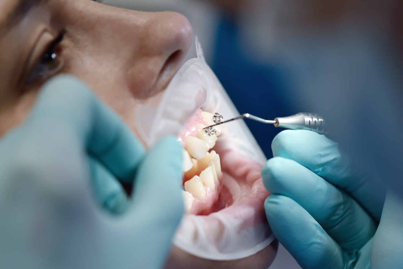 Dentist Installing Braces on Patient's Teeth