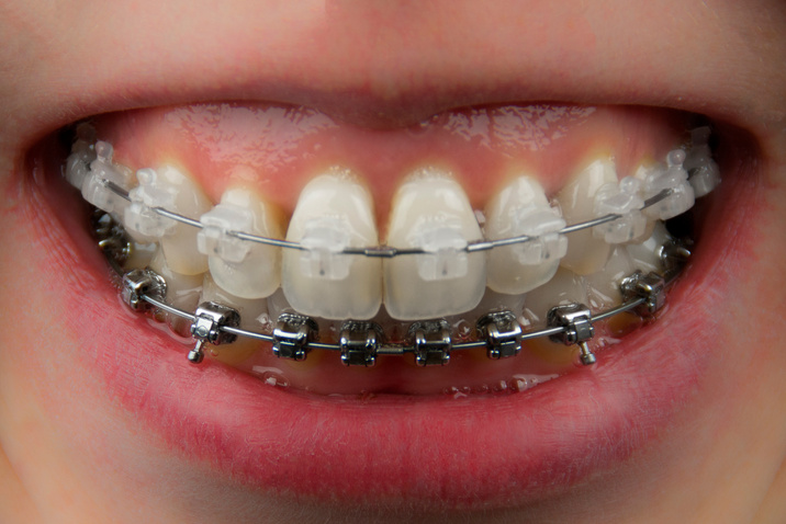 Teeth with ceramic and metal braces closeup